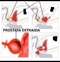 Adenoma prostático extraído por cirugía abierta