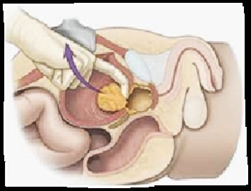 Plano de enucleación del adenoma prostático