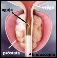 Inyección intraprostática a través del endoscopio