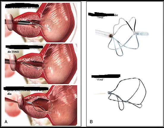 Dispositivo implantable temporal de nitinol (iTIND)