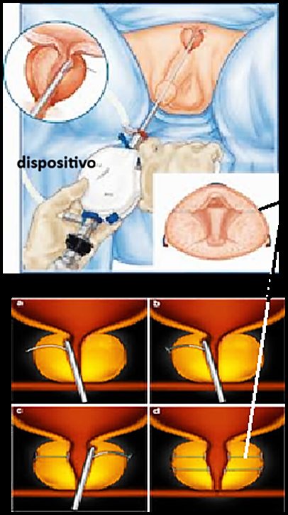 Colocación del dispositivo iTIND