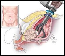 Diagrama de la prostatectomía asistida con robot
