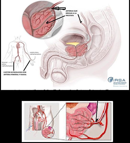 Embolización de las arterias de la próstata