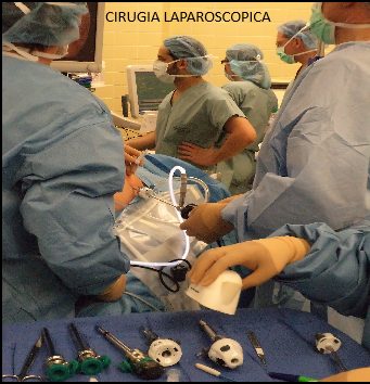 Laparoscopia