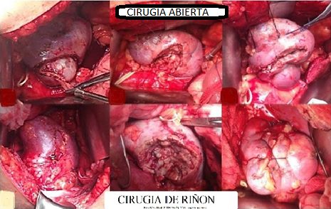 Cirugía Renal