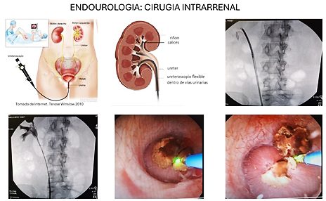 Endourología