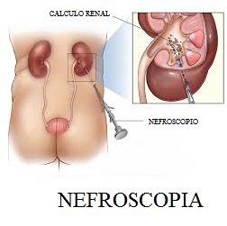 Nefroscopia