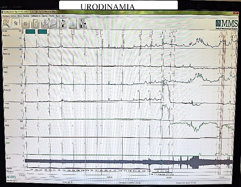 Uroflujometría