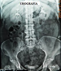 Urografía Excretora